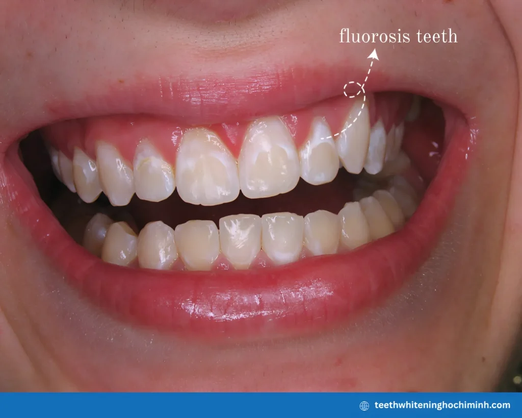 best fastest teeth whitening method