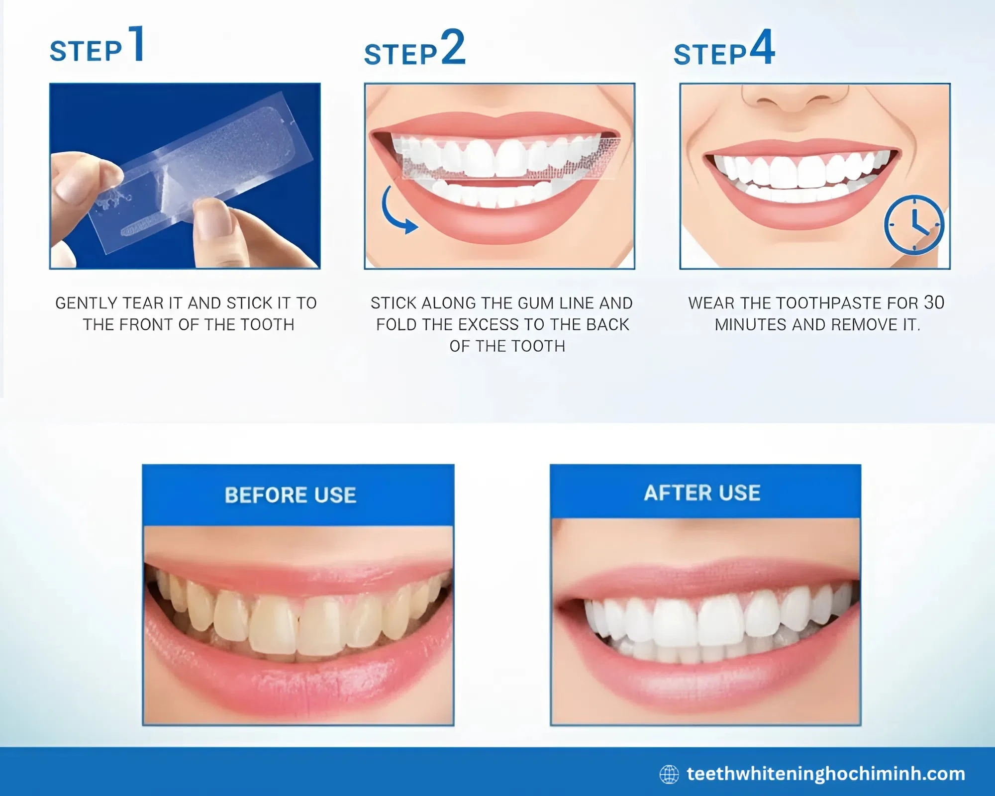over the counter teeth whitening