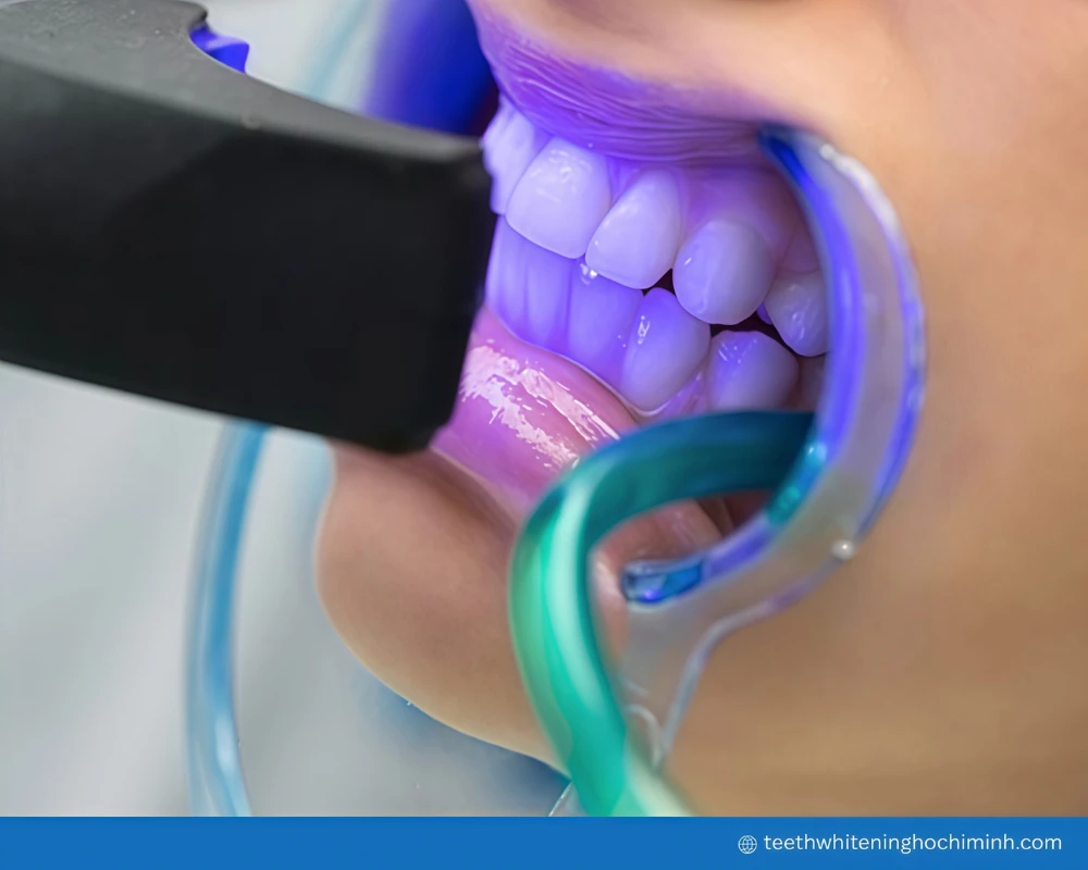 teeth whitening uv light