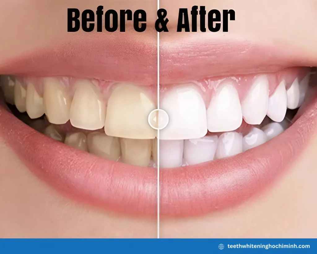 can you get teeth whitening with crowns