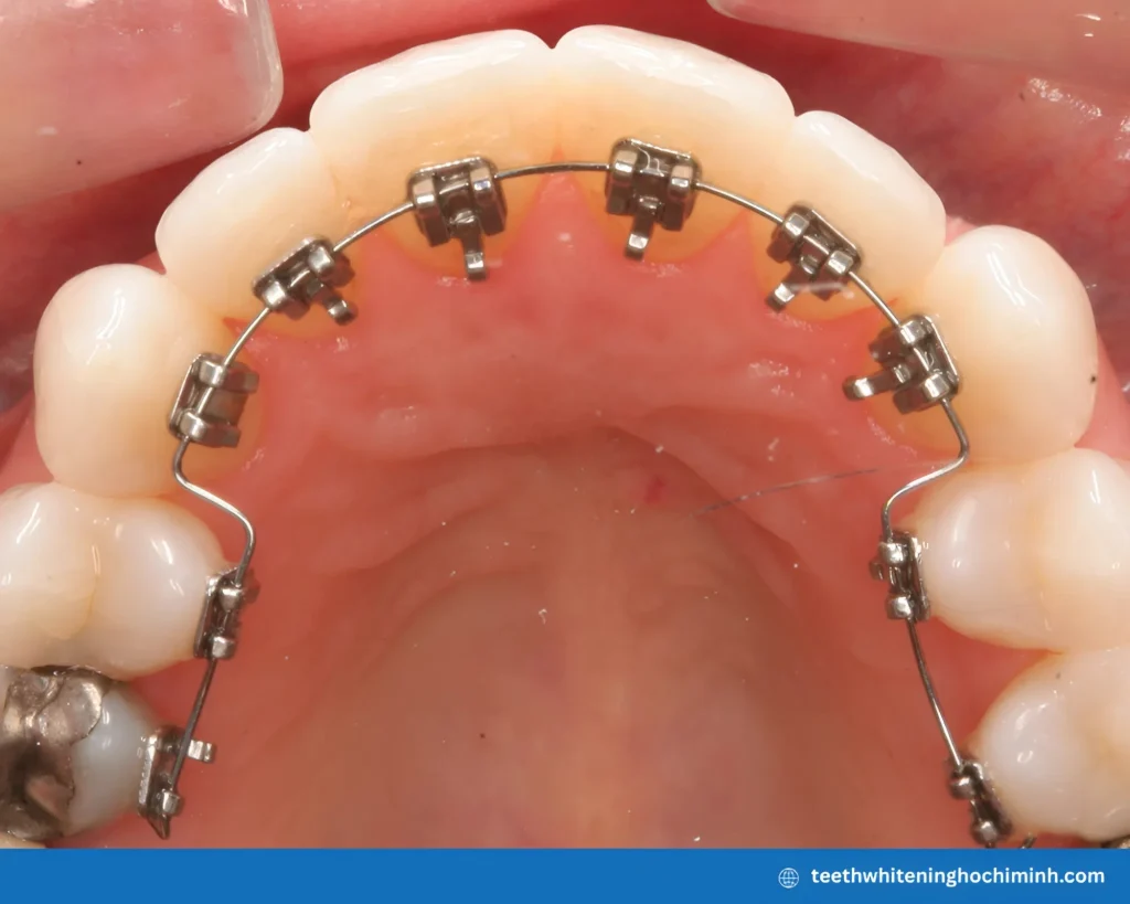 teeth whitening strips with braces