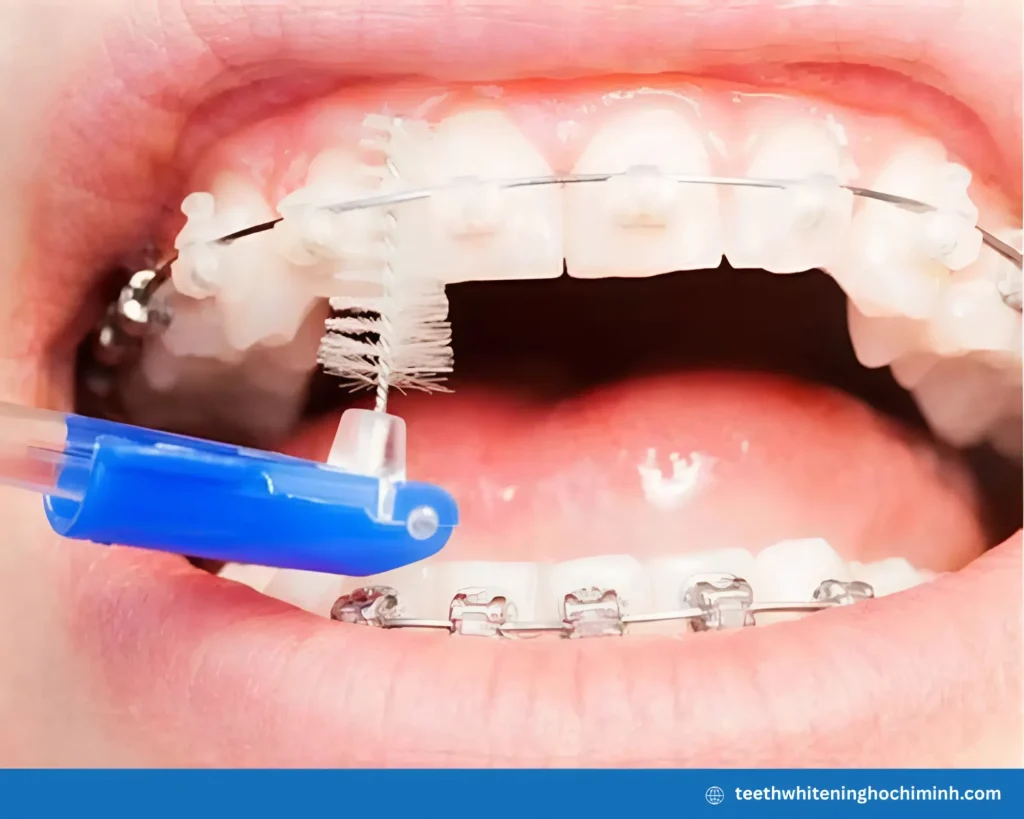 can i use teeth whitening with braces