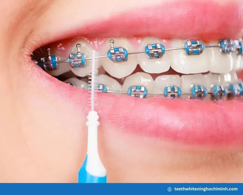 teeth whitening with braces stains