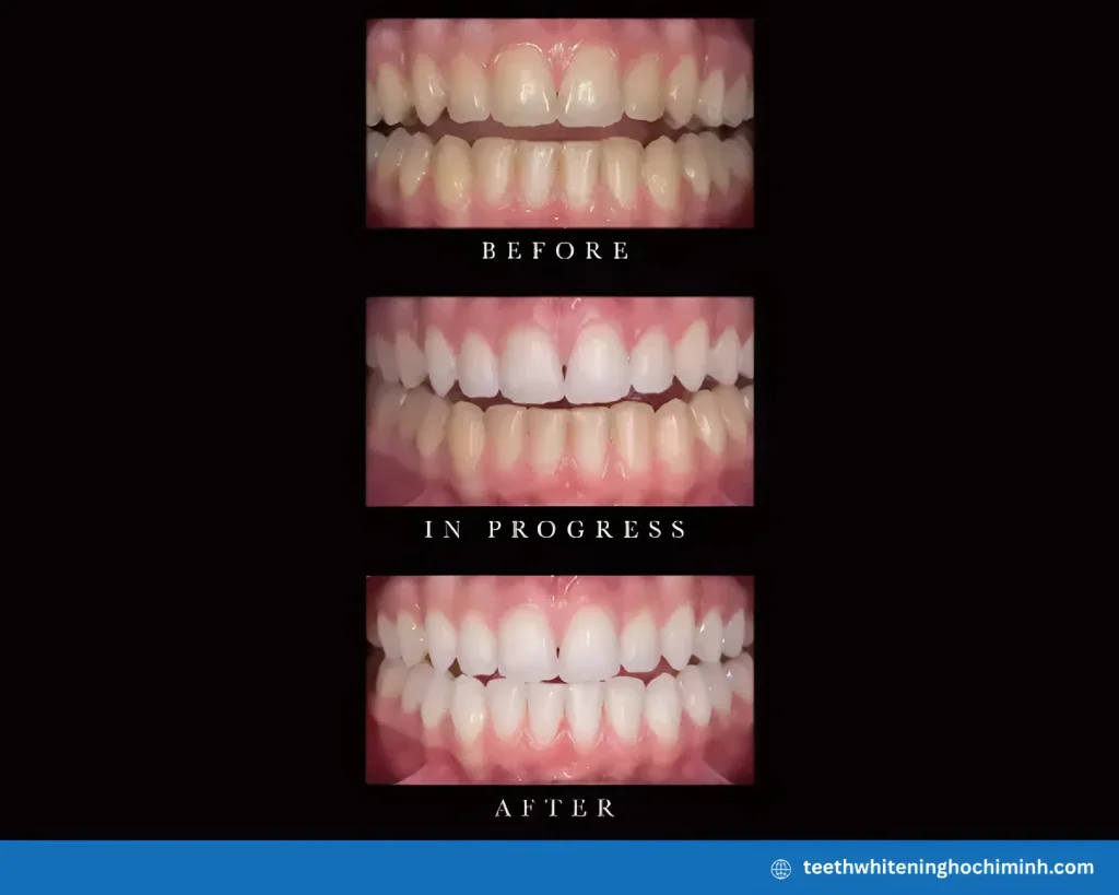 crest 3d whitestrips with light teeth whitening strip kit