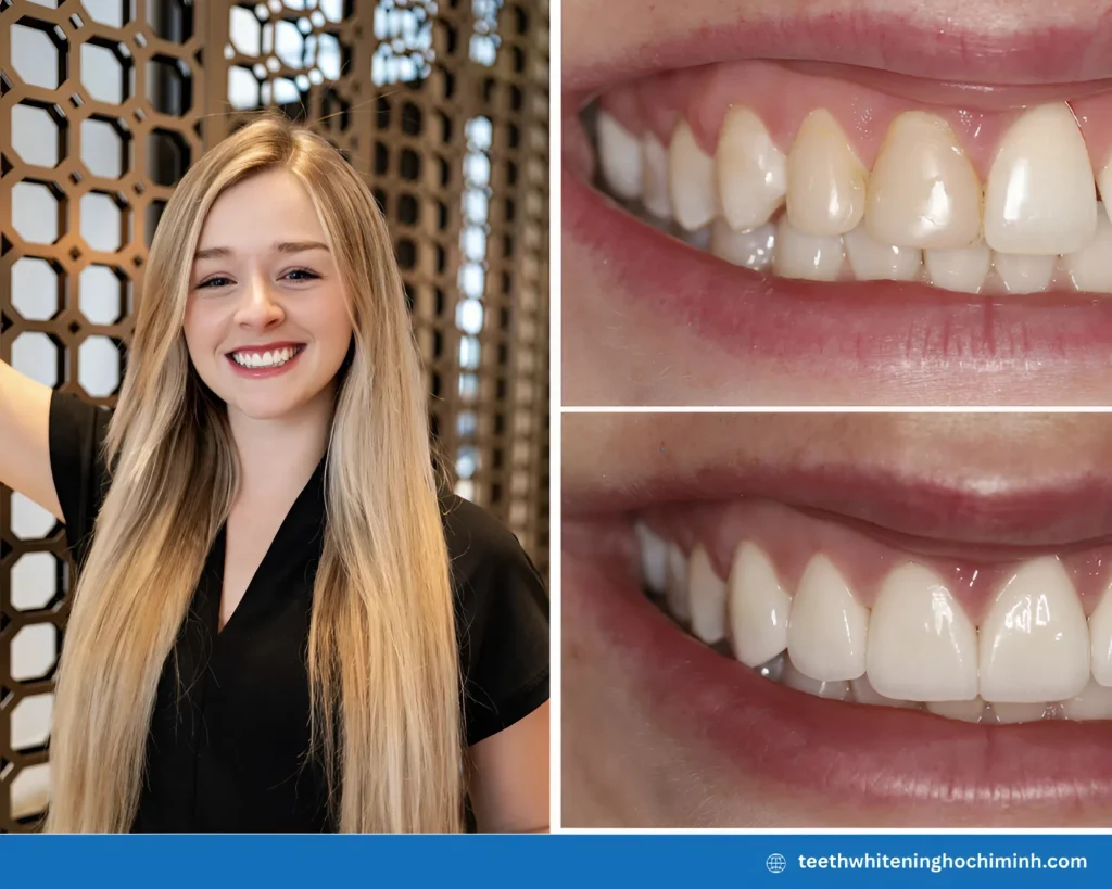 crest 3d whitestrips sensitive white teeth whitening kit results