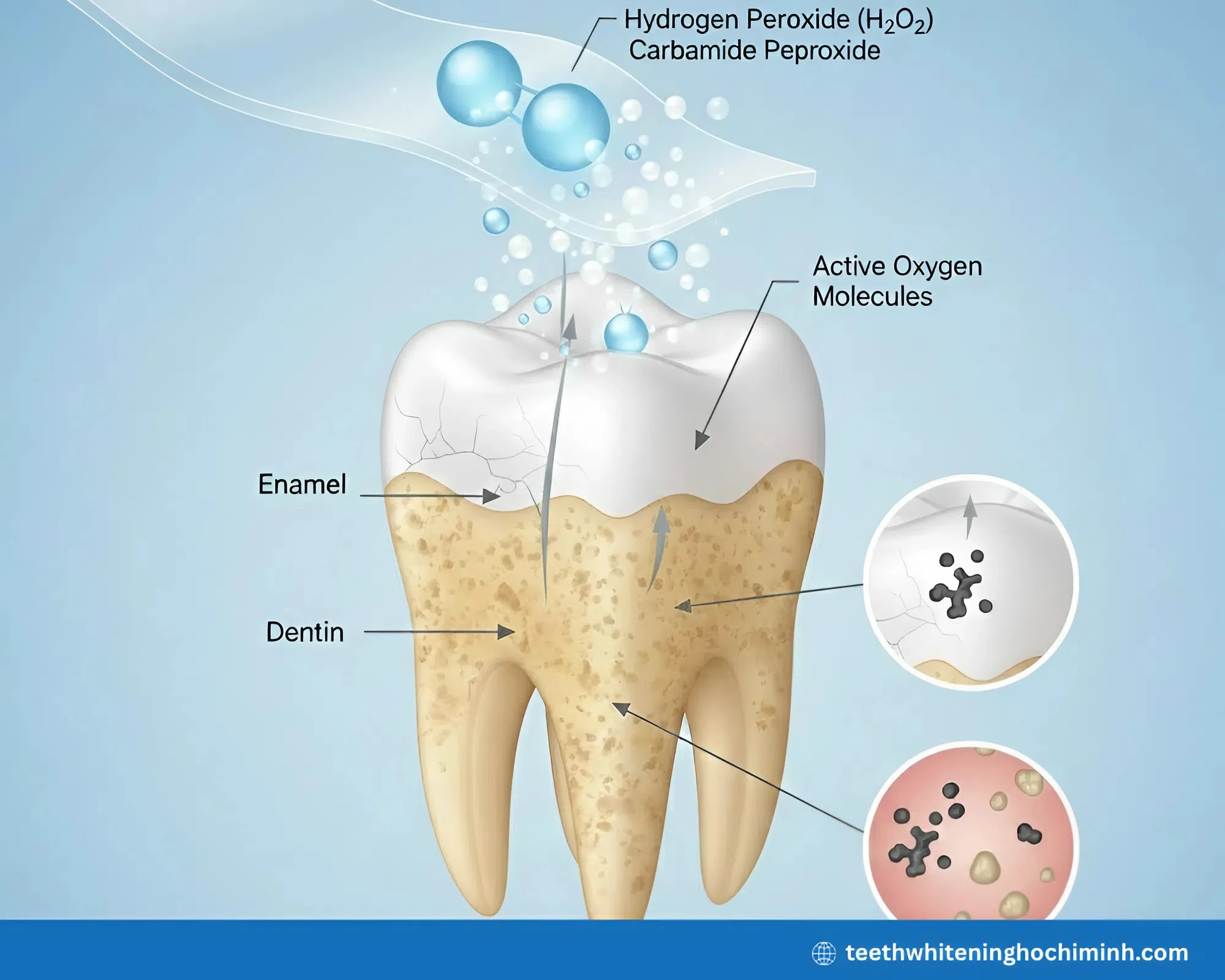 Internal teeth whitening
