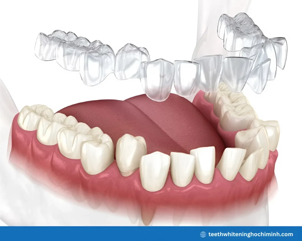 teeth guard for whitening