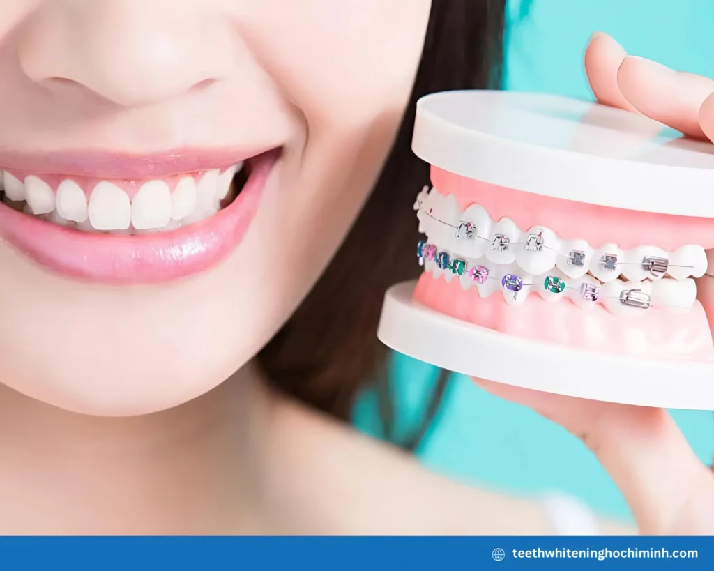 teeth whitening after braces removal