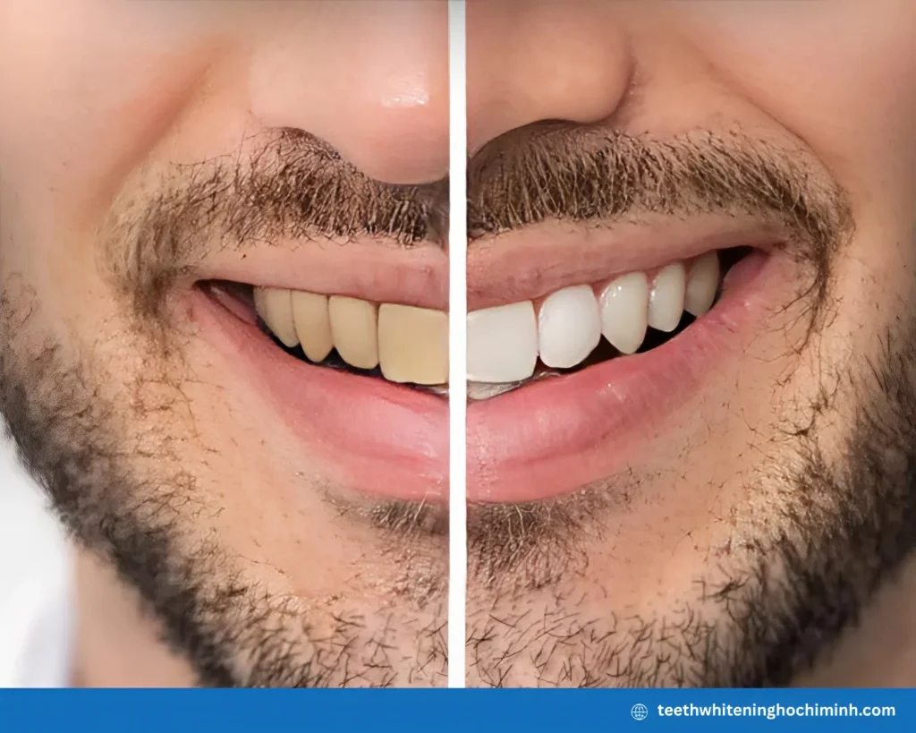 best at home teeth whitening for smokers