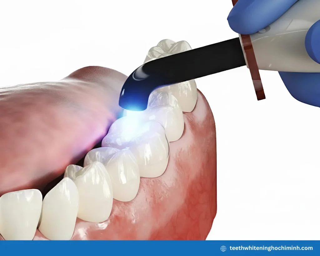 laser whitening cost