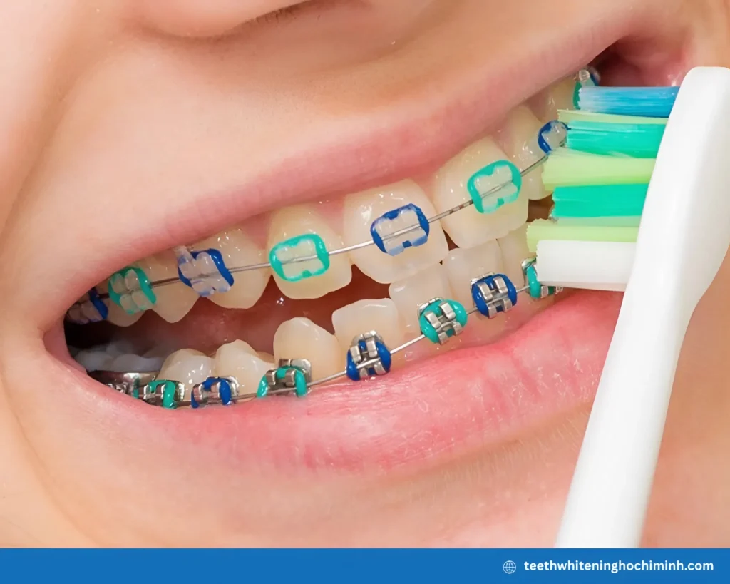 can you do teeth whitening with braces