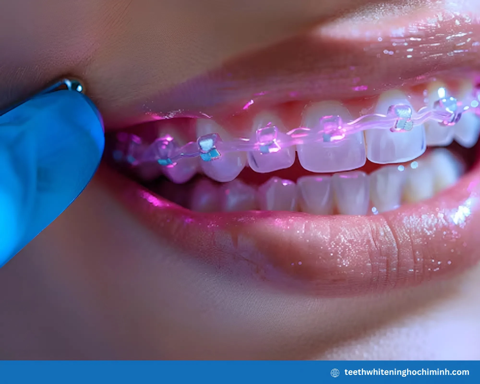 teeth whitening with braces