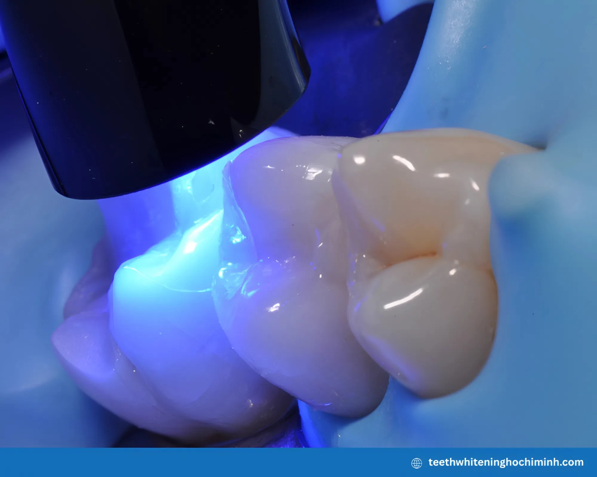 Zoom teeth whitening