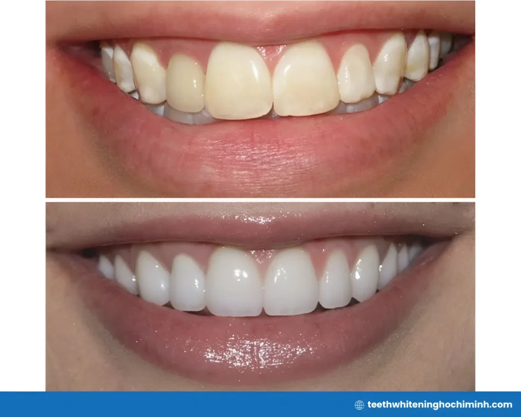 teeth whitening with fluorosis