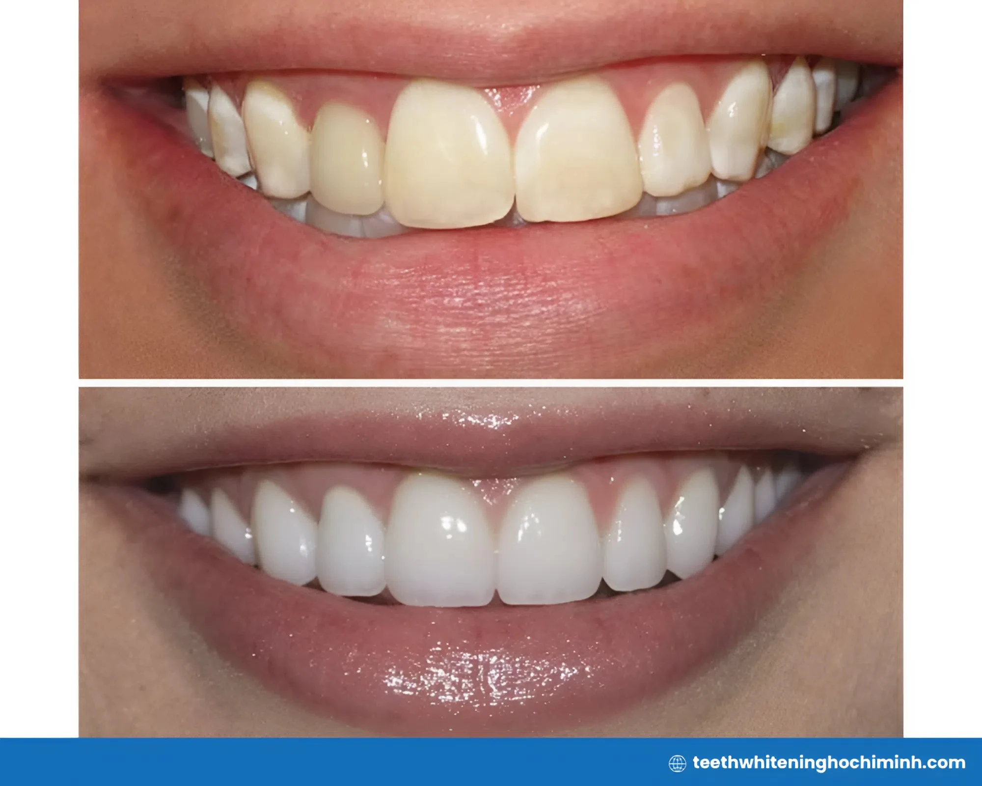 fluorosis teeth whitening