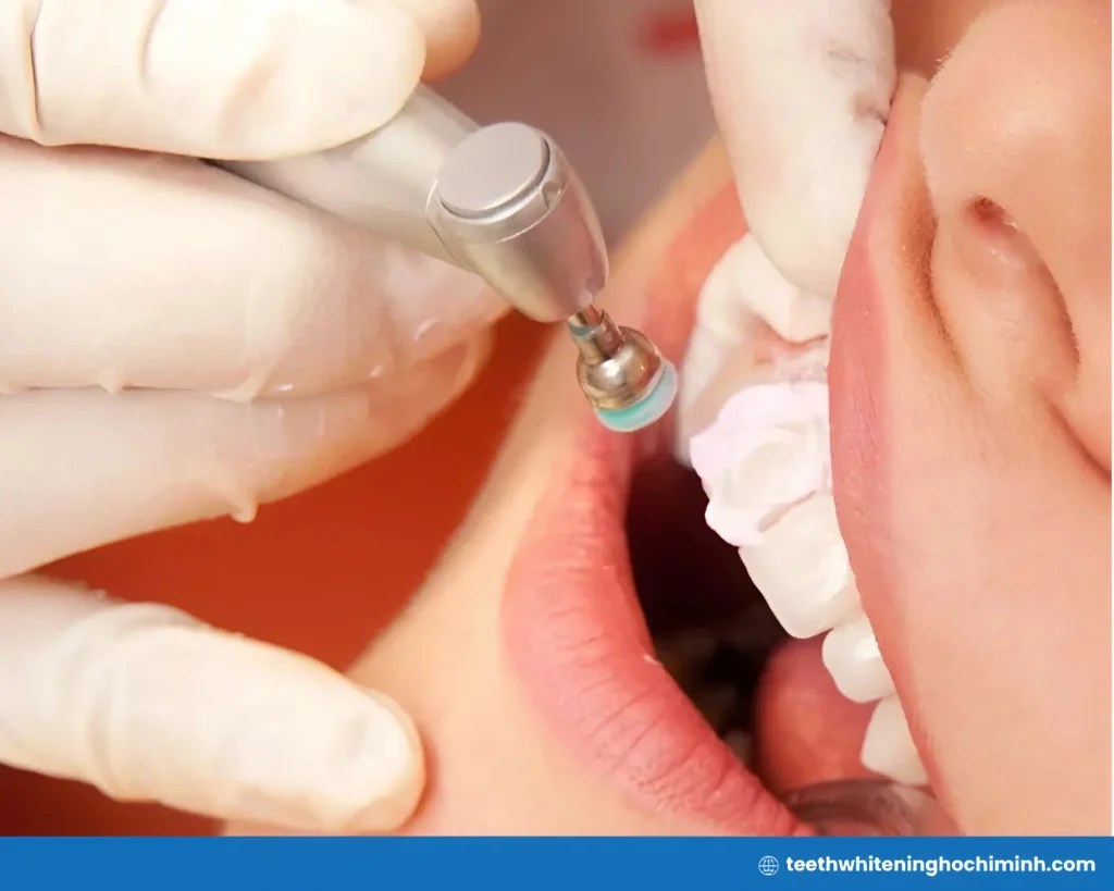 fluorosis teeth whitening