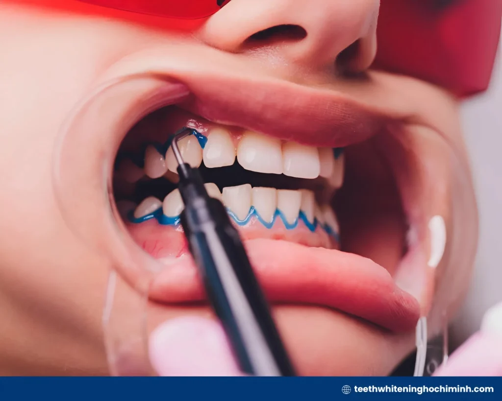 laser whitening cost