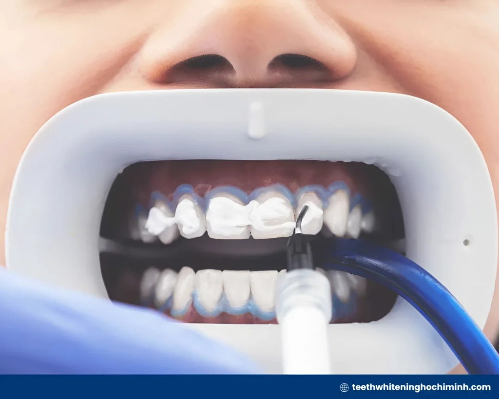 whitening teeth laser cost