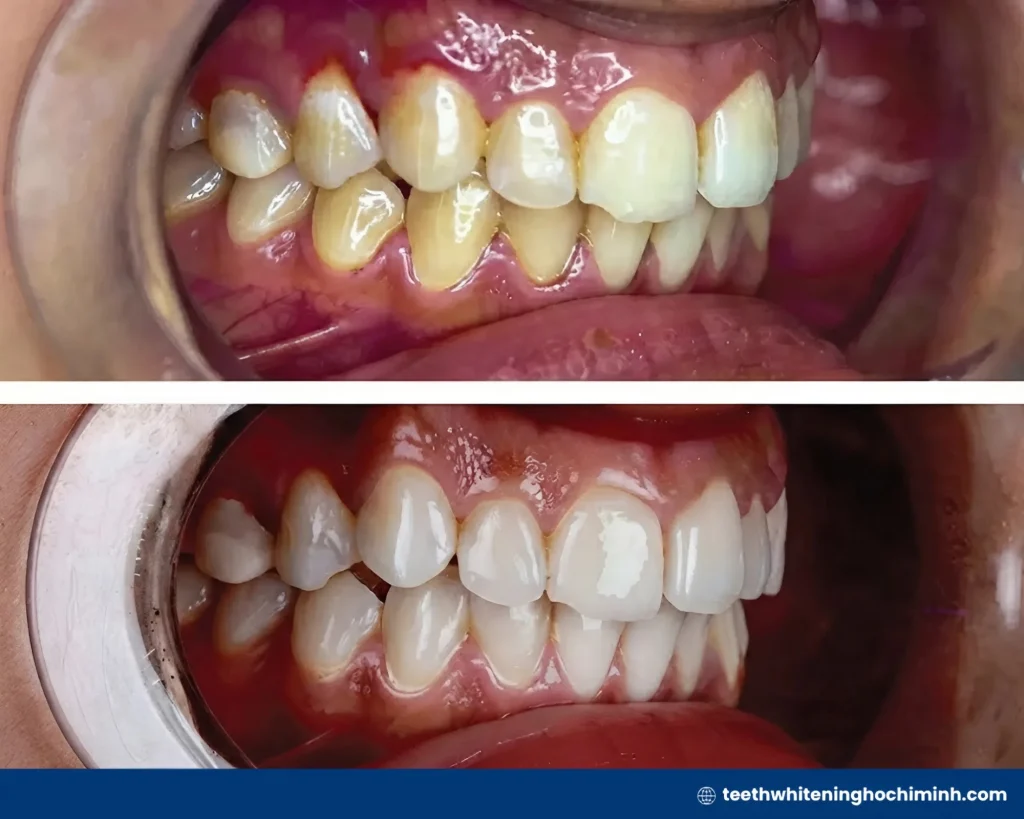 laser teeth whitening cost