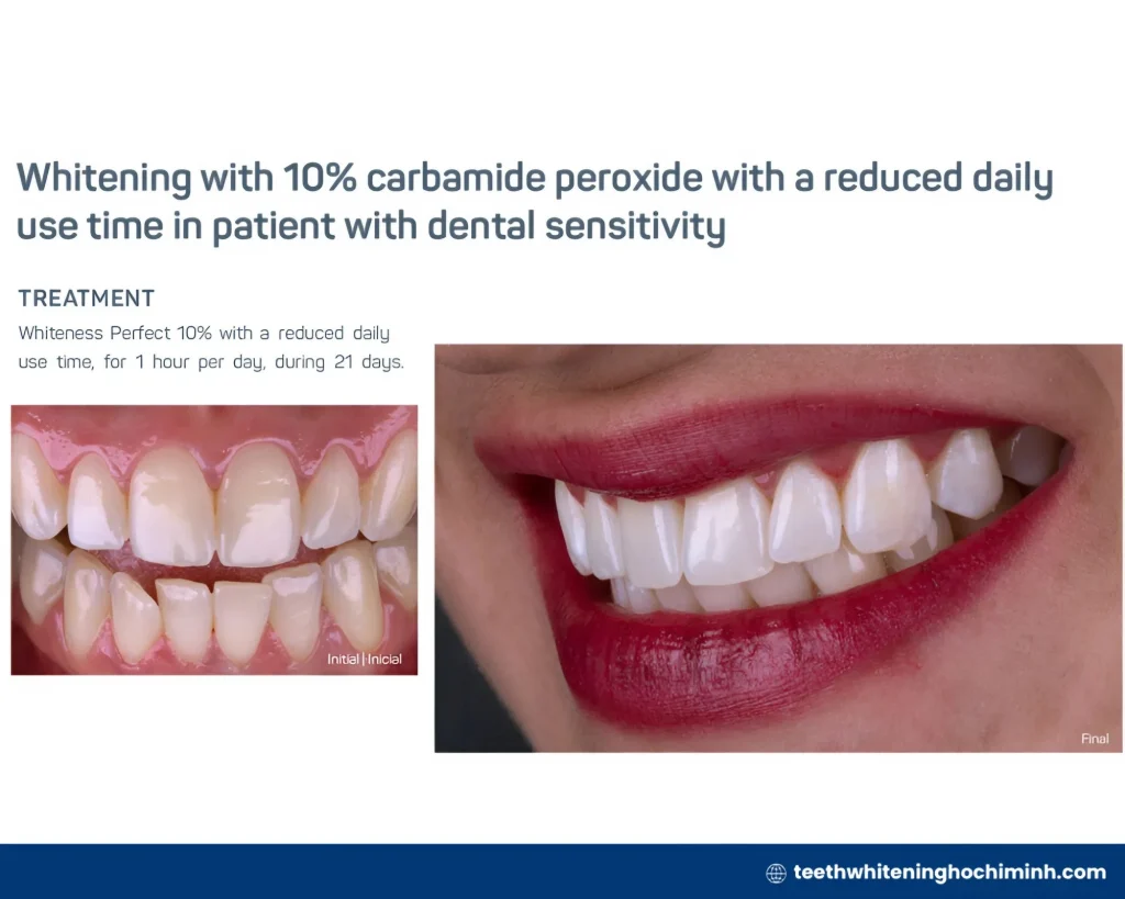 best at home teeth whitening
