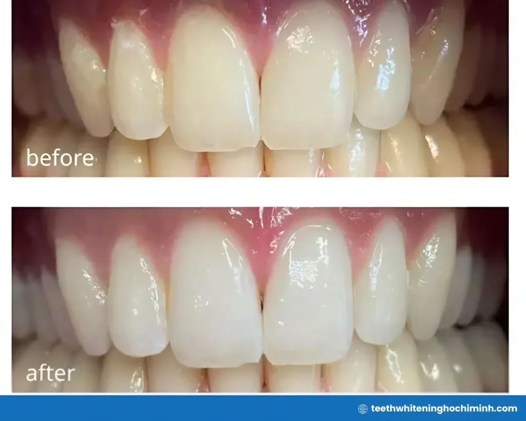 opulence teeth whitening kit