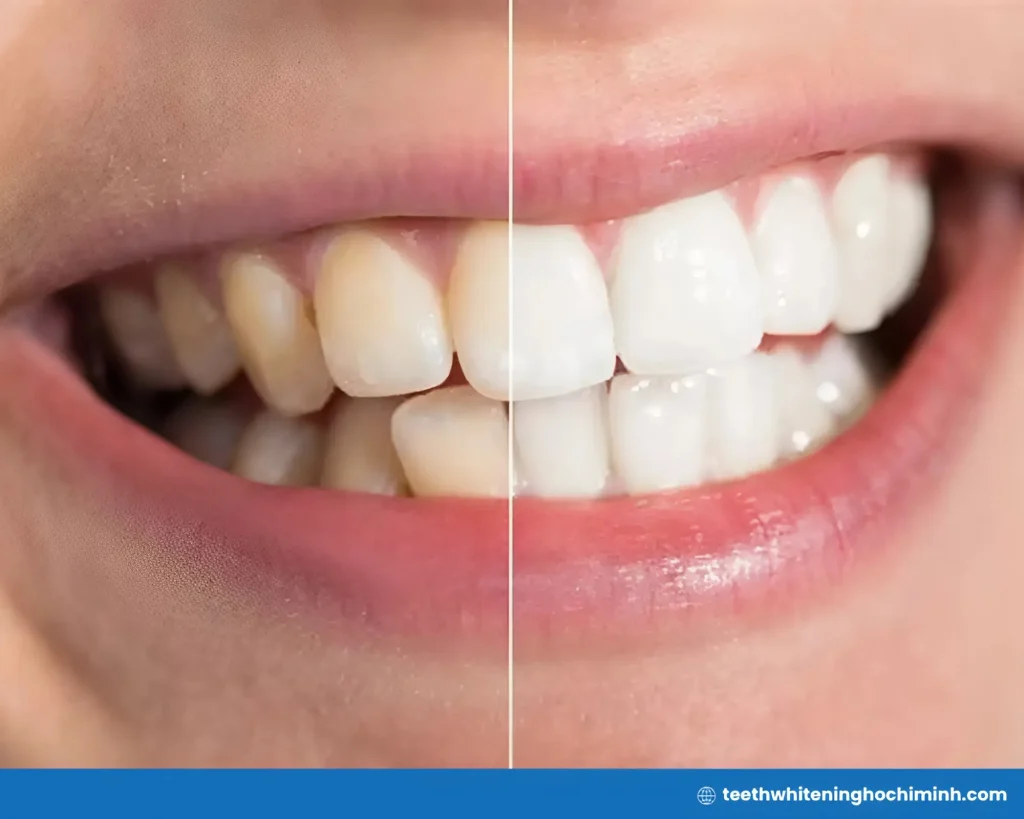 teeth whitening with baking soda and hydrogen peroxide