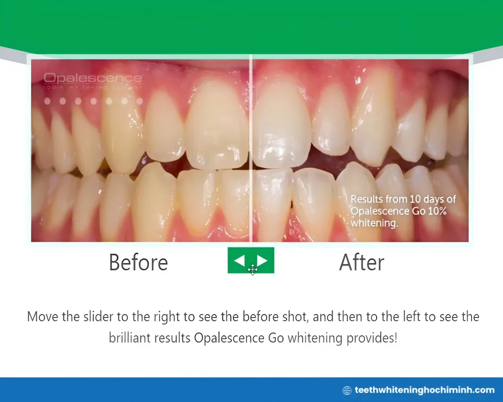 opalescence boost teeth whitening