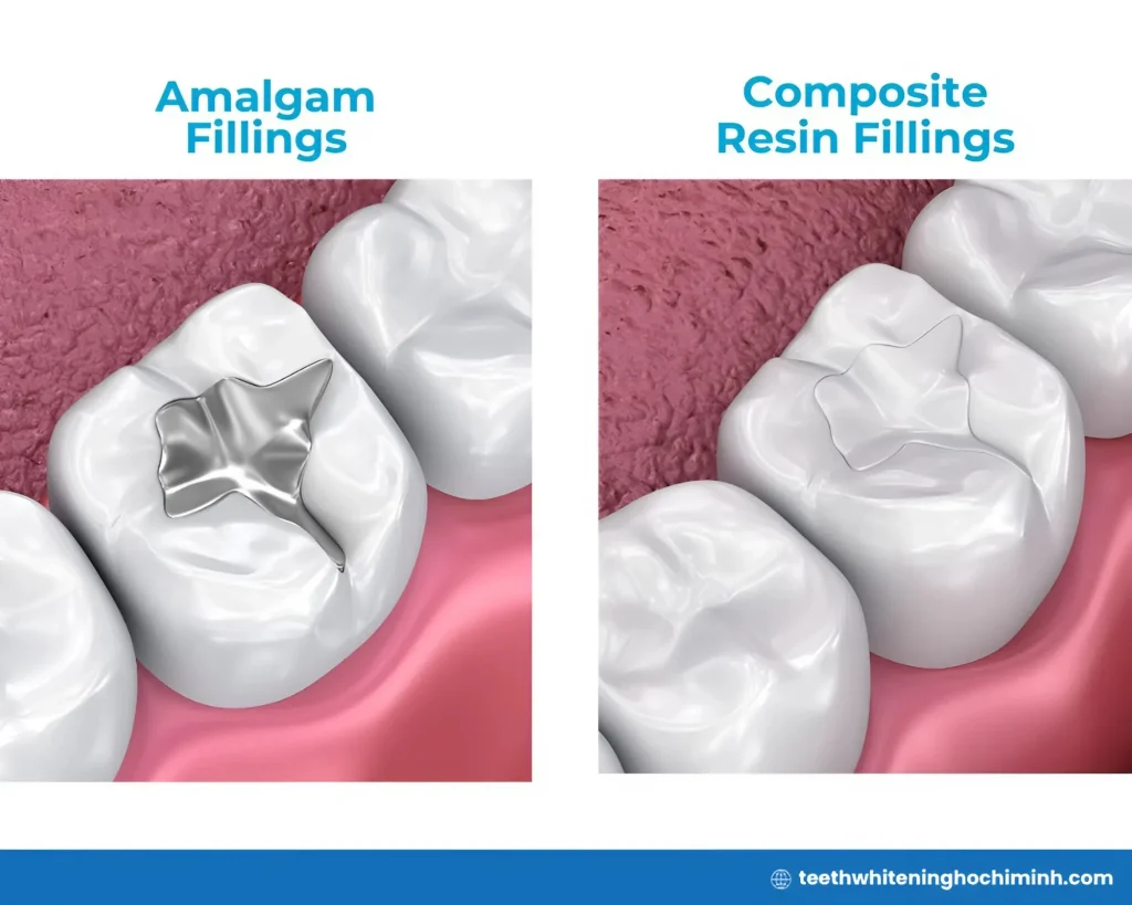 teeth whitening fillings