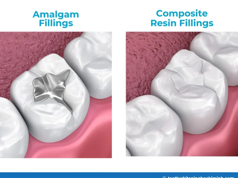 teeth whitening fillings