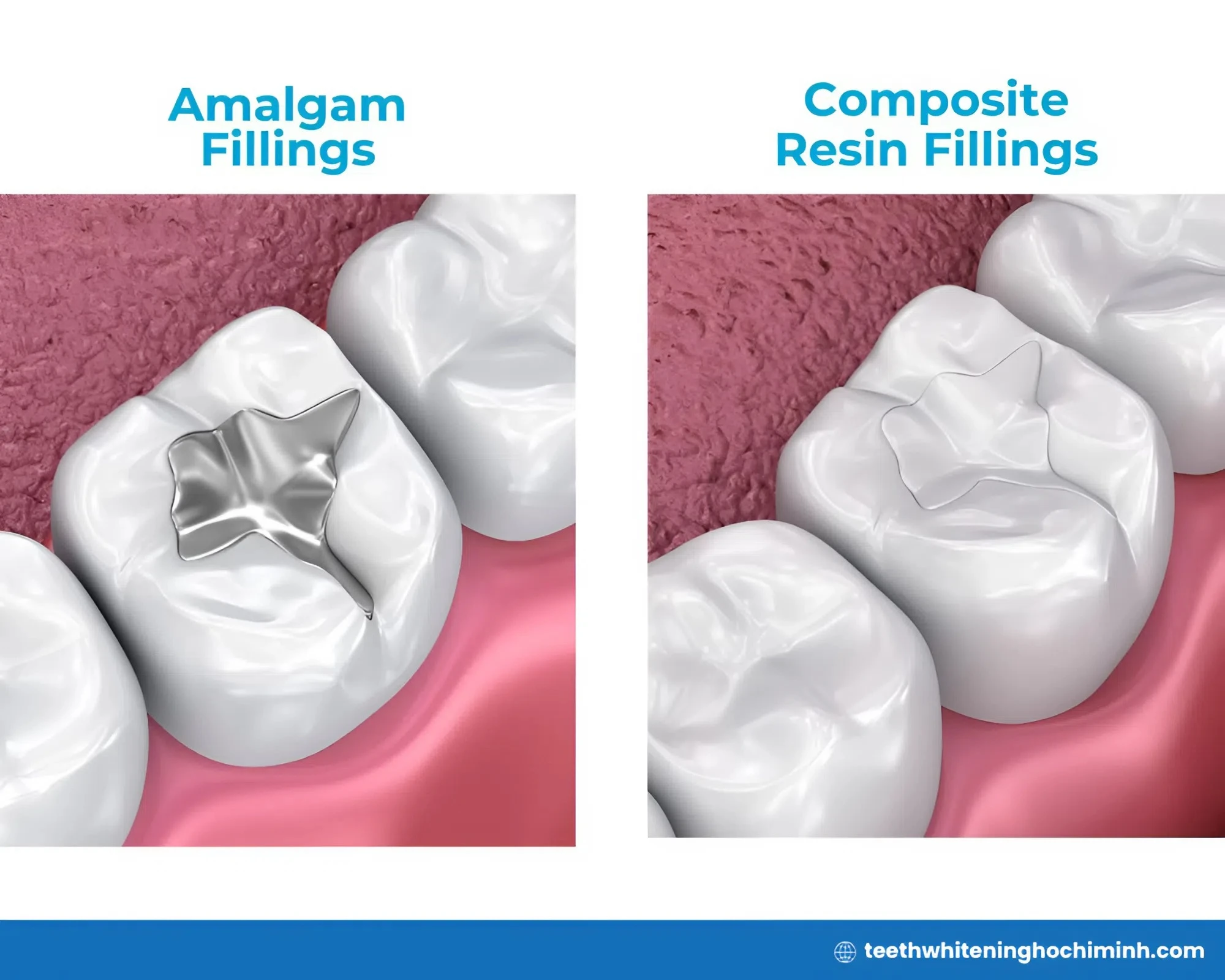 teeth whitening fillings