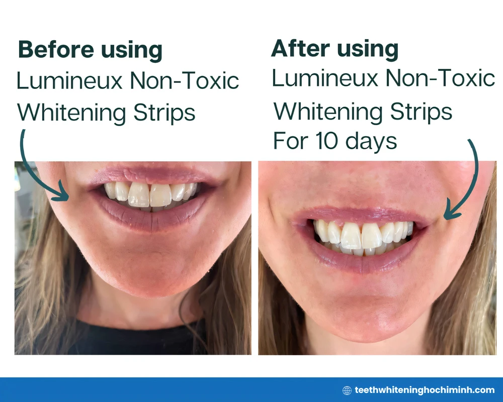 lumineux teeth whitening before and after