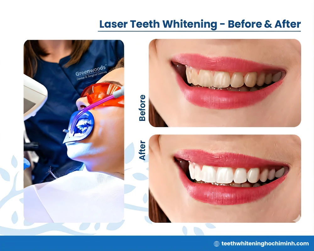 whitening teeth dentist