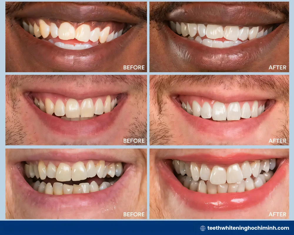 zoom teeth whitening at home