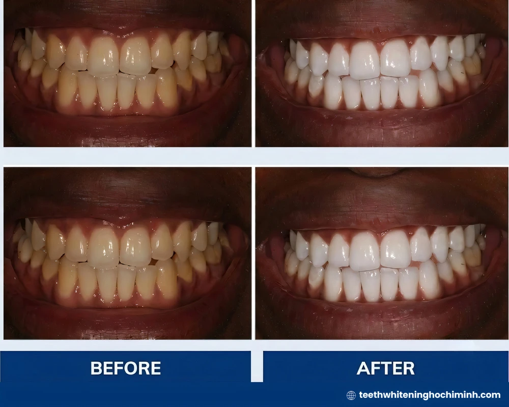 philips zoom teeth whitening cost