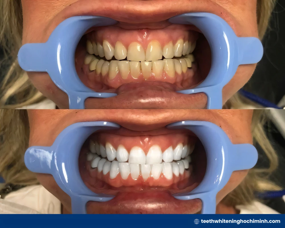 cost of zoom teeth whitening
