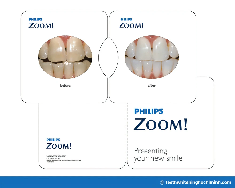cost of philips zoom teeth whitening