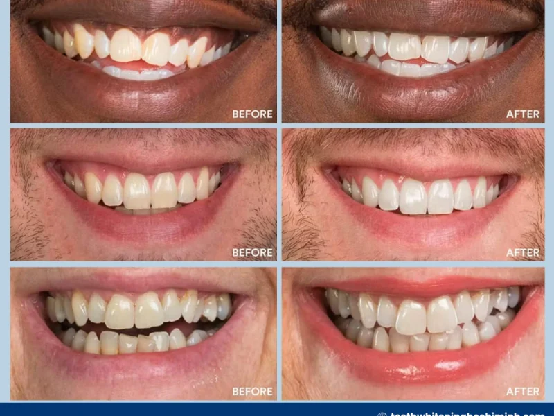 zoom teeth whitening before and after