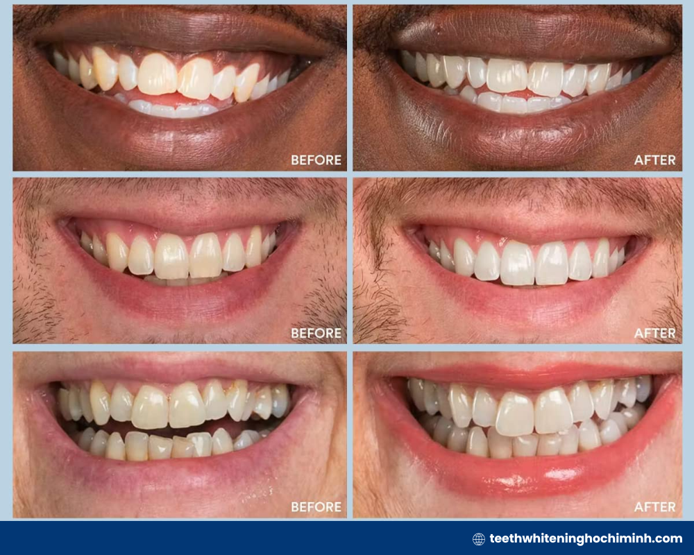 Cheapest teeth whitening: 4 best affordable options 2026