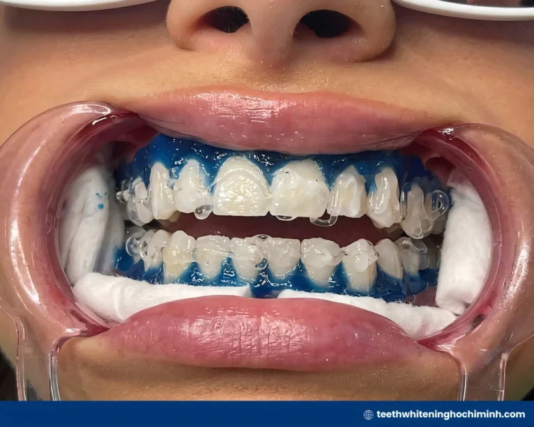 zoom teeth whitening treatment