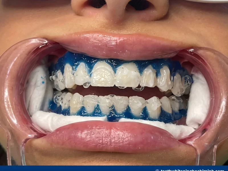 zoom teeth whitening treatment