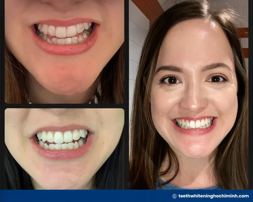 zoom teeth whitening before after