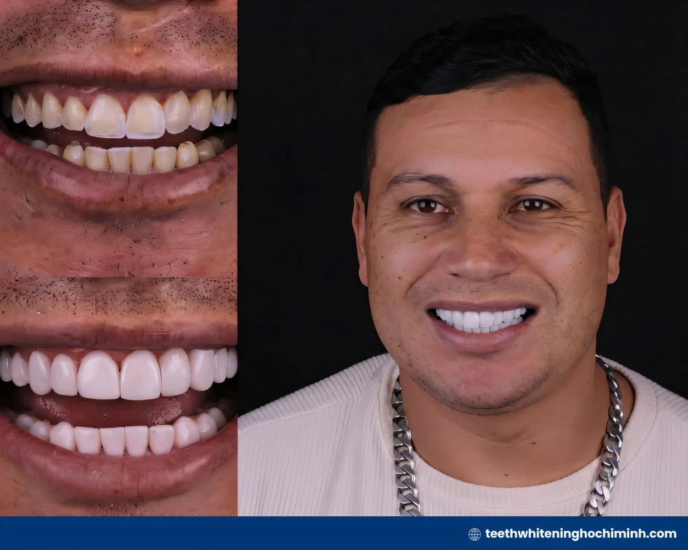 what is zoom teeth whitening treatment