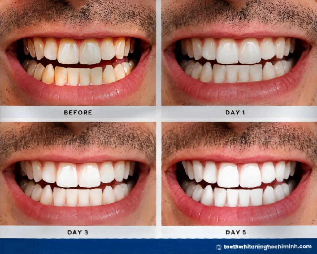 best professional teeth whitening method