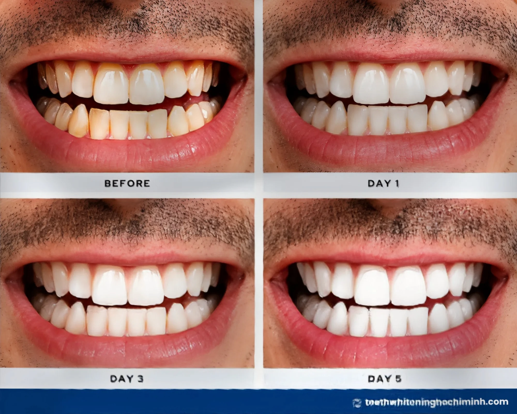 best teeth whitening method