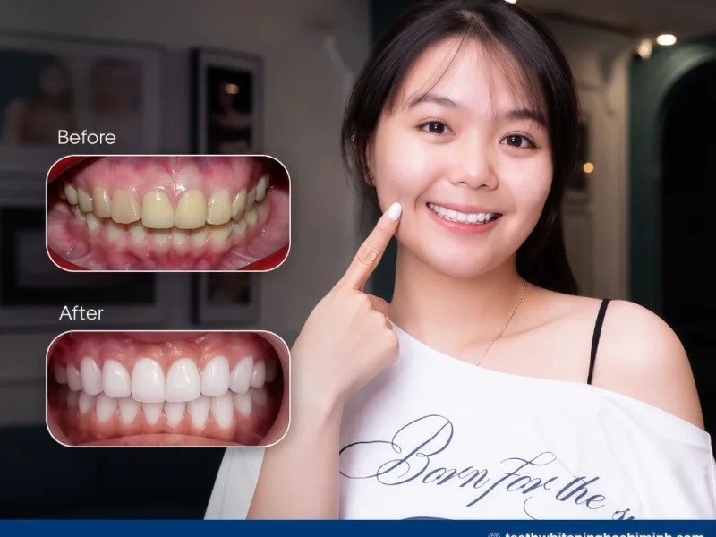 best teeth whitening procedure