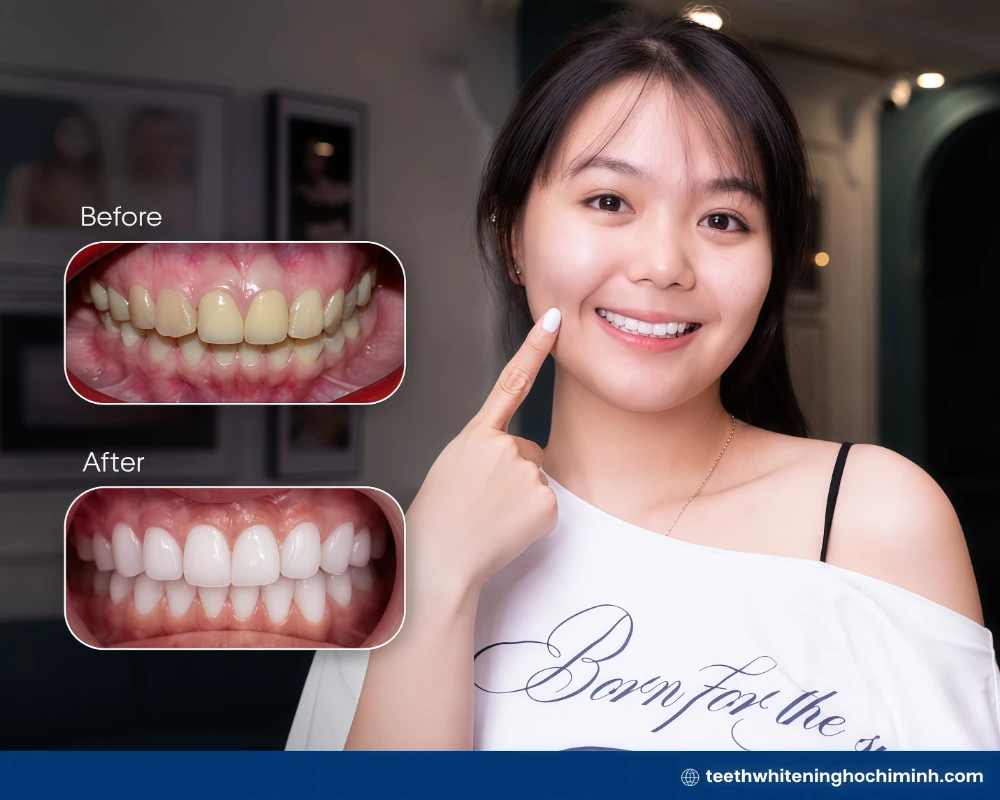 the best teeth whitening procedure