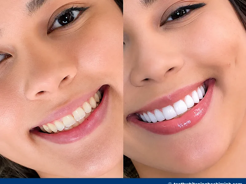 philips zoom at home teeth whitening