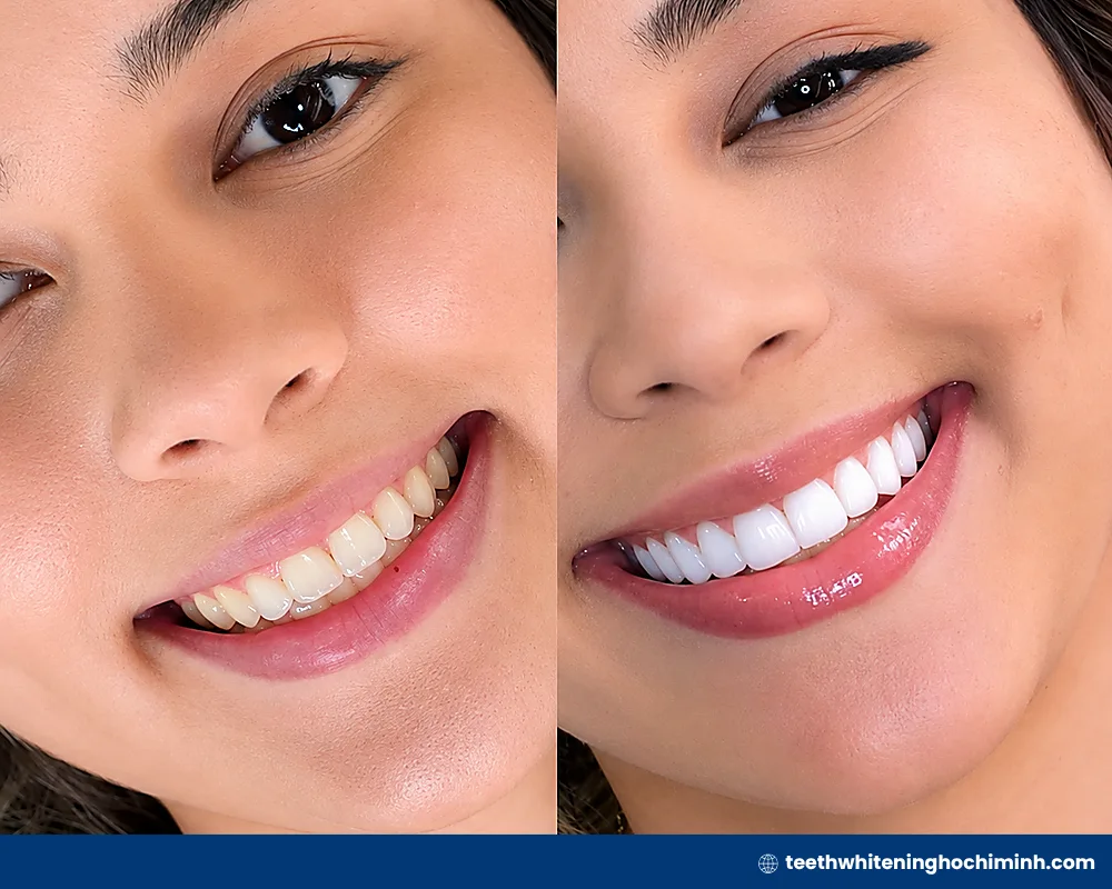 Best teeth whitening after braces to remove stains fast [2026]