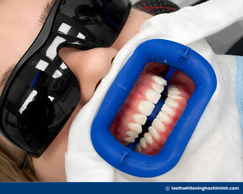 zoom teeth whitening pros cons