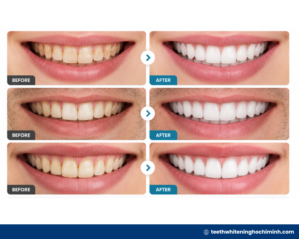 teeth whitening treatment results